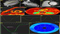 early detection of cardiac disorders in thalassemia major patien